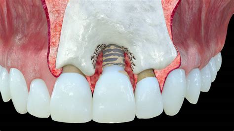 Rubbers: Revolutionizing Dental Implants and Beyond!