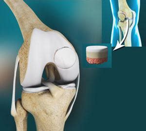  Osteochondral Composites for Reconstructing Damaged Joints: Can We Build Better Bones and Cartilage?